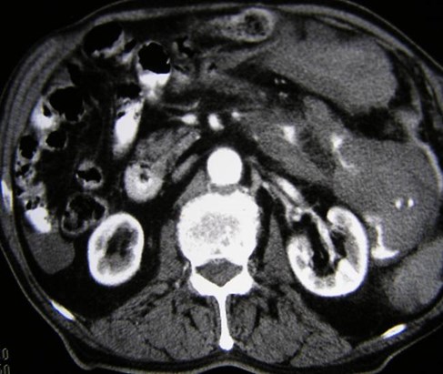 abdominal trauma ct radiopaedia